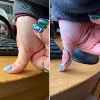 Thumb ring splint stabilising my hyperextending IP joint